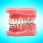 Mouth mold with braces