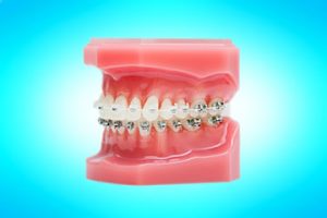 Mouth mold with braces